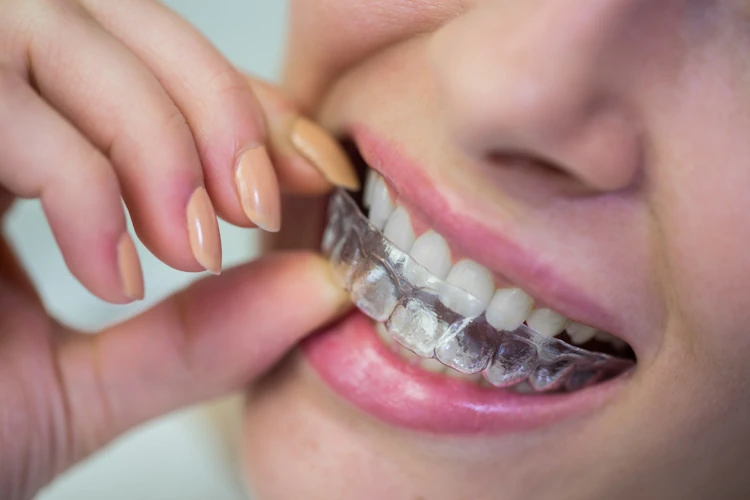 Invisible Braces: How Clear Aligners Can Transform Your Teeth